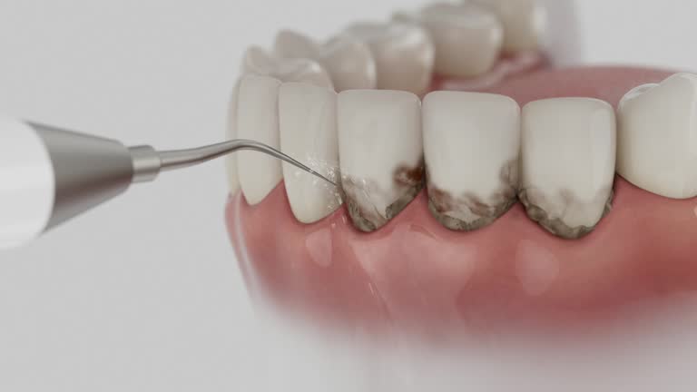 Trusted Wisdom Tooth Removal service in Edmonston, MD - Dentist Open Now